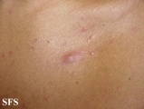 eosinophilic folliculitis of hiv aids
