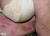 herpes zoster-varicella