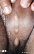 scrotal cyst