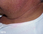chromhidrosis
