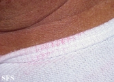 chromhidrosis