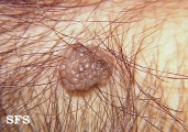 melanocytic naevi