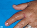 erysipeloid