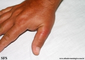erysipeloid