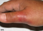 erysipeloid