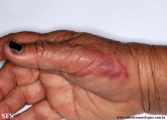 erysipeloid