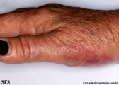 erysipeloid