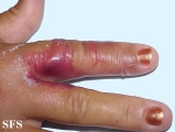 erysipeloid