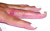 erysipeloid