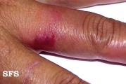 erysipeloid
