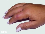 erysipeloid