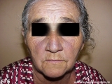 hyperpigmentation due to amiodarone