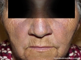 hyperpigmentation due to amiodarone