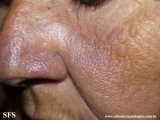 hyperpigmentation due to amiodarone