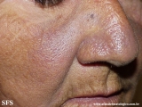 hyperpigmentation due to amiodarone