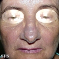hyperpigmentation due to amiodarone