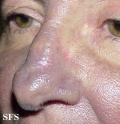 hyperpigmentation due to amiodarone