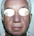hyperpigmentation due to amiodarone
