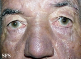 hyperpigmentation due to amiodarone