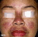 lupus erythematosus-systemic lupus erythematosus