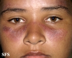 lupus erythematosus-systemic lupus erythematosus