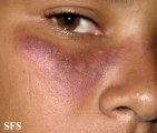 lupus erythematosus-systemic lupus erythematosus