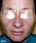 lupus erythematosus-systemic lupus erythematosus