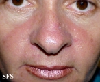 lupus erythematosus-systemic lupus erythematosus