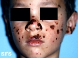 hydroa vacciniforme
