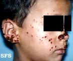 hydroa vacciniforme