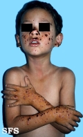 hydroa vacciniforme