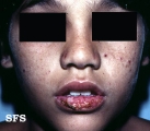 hydroa vacciniforme