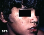 hydroa vacciniforme