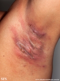 hidradenitis