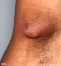 hidradenitis