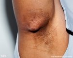hidradenitis
