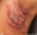 hidradenitis