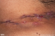 hidradenitis