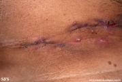 hidradenitis