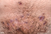 hidradenitis