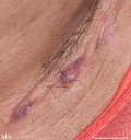 hidradenitis