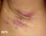hidradenitis