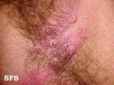 hidradenitis