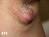 hidradenitis