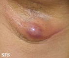 hidradenitis