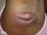 hidradenitis