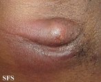 hidradenitis