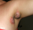 hidradenitis