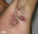 hidradenitis