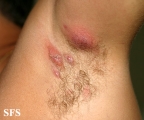 hidradenitis